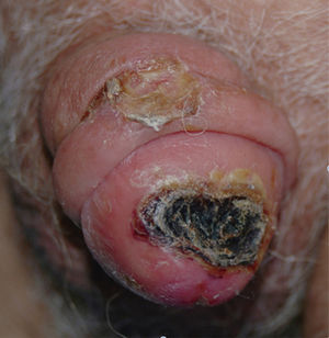 Visión frontal de los hallazgos clínicos, con dos lesiones ulceradas, necróticas, con piel eritematosa indurada circundante en el glande del pene.