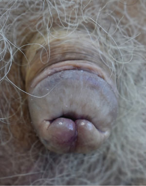 Remisión de lesiones cutáneas bajo tratamiento con adalimumab 40mg/14días.