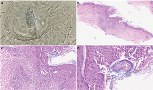 Prueba parasitológica e imágenes histopatológicas de las lesiones cutáneas. (a) Prueba cutánea parasitológica que muestra DF. (b, c) Con menor potencia, las imágenes dermatopatológicas muestran un infiltrado linfocítico perifolicular pronunciado alrededor de los folículos pilosos (tinción hematoxilina-eosina, ampliación original (b) ×40 y (c) ×100. (d) Imagen de alta potencia que muestra una estructura tubular consistente con DF (tinción hematoxilina-eosina, ampliación original ×400).