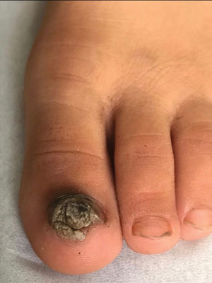 Hiperqueratosis subungueal parda y onicólisis.