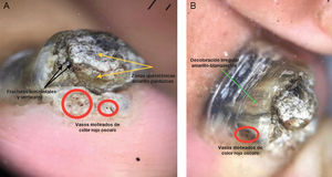 (A) Dermatoscopia del borde libre de la uña: zonas queratósicas amarillo-parduscas con escamas (flecha amarilla) y fracturas horizontales y verticales (flecha negra) dispuestas en patrón de huevos de rana (círculo rojo). (B) Dermatoscopia de la lámina ungueal: decoloración irregular amarillo-blanquecina (flecha verde).