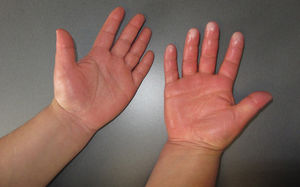 Case #1: Hyperhidrosis, edema, and acral cyanosis of the right hand.