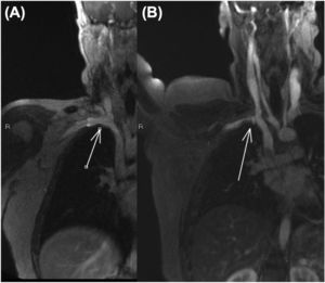 Case #1: Dynamic MRI: (A) Patent right subclavian vein (arrow) in adduction. (B) Compressed right subclavian vein (arrow) with abduction.
