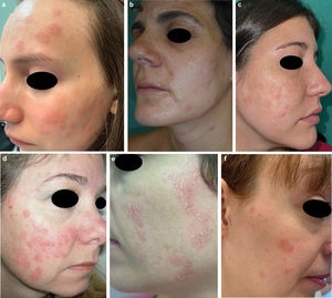 Clinical characteristics. (a–f) Numerous nummular, erythematous-orange papules-plaques with dry scaling on the surface, mainly on the cheeks and forehead in patients #2, #3, #4, #9, #11, and #13, respectively. Presence of cervical lesions in patient #3 (b).