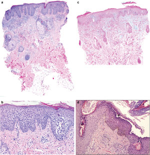 Histological characteristics. (a) Biopsy of one of the facial lesions, presence of regular/psoriasiform hyperplasia associated with confluent parakeratosis and dilated follicular structures. The absence of neutrophils within the epidermal layers stands out. In addition, perivascular lymphohistiocytic infiltrates and mild atrophy of sebaceous glands are observed (patient #2, H&E, panoramic view). (b) Biopsy from patient #4 revealing the presence of epidermis with acanthosis, parakeratosis, and foci of spongiosis more accentuated at the level of the follicular epithelium (H&E, ×40). (c) Alcian blue staining reveals the presence of mucin in the mid-dermis (patient 5, ×20). (d) Subcorneal acantholysis in the biopsy sample from patient #10 (asterisk), along with basal hyperpigmentation, pigment-laden macrophages in the dermis, and a mild perivascular lymphocytic infiltrate. Presence of Demodex in the follicular orifice (H&E, ×20).
