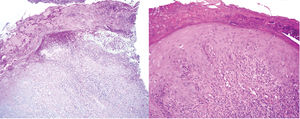Hematoxylin–eosin staining. Biopsy of the edge of the ulcer, with a dense and diffuse intradermal inflammatory infiltrate, rich in neutrophils, and areas of tissue necrosis.
