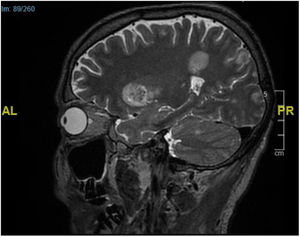 Hallazgos histológicos (tinción H&E). A) Biopsia cutánea de una placa: invasión extensa de la dermis superficial y la epidermis hasta el estrato córneo (×10). B) Biopsia de un nódulo subcutáneo: necrosis grasa de tipo paniculitis y presencia de hifas en tejido adiposo (×20).