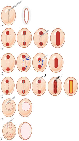 Representación esquemática de las opciones quirúrgicas para la hidradenitis supurativa. (A) Incisión quirúrgica y drenaje. (B) Deroofing. (C) Colocación de Seton. (D) Escisión para preservar la piel con peeling electroquirúrgico. (E) Escisión lesional. (F) Escisión regional.
