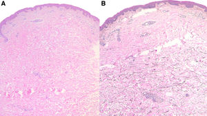 (A) Histology with Hematoxylin & Eosin stain [40×]. (B) Histology with Orcein staining [40×].