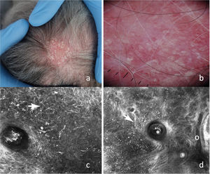 A) Placa eritematodescamativa en vértex. B) Dermatoscopia: se observa eritema difuso, tapones foliculares así como vasos arboriformes finos. C) MCR epidérmico: se observan células de morfología dendrítica de distribución peri e interfolicular (). D) MCR en la UDE: se observa tapón folicular (*), infiltrado inflamatorio conformado por células de morfología redonda () así como vasos dilatados (o).