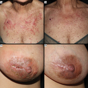 Imágenes de casos con LEC tipo LECA y LECP previo a tratamiento con anifrolumab (a) y tras dos infusiones de anifrolumab 300mg/mensual (b). Las imágenes1 corresponden al caso número 4 de la tabla, y en ellas se observan lesiones de LECA en forma de placas eritematosas y edematosas por área fotoexpuesta de aparición aguda en zona de escote que curan sin cicatriz tras el tratamiento. Las imágenes2 corresponden al caso número 2 de la tabla, y se observan lesiones de mastitis lúpica (LECP) en forma de placa indurada e infiltrada, descamativa, con afectación profunda, fisurada, que se resuelve dejando cicatriz tras el tratamiento.