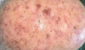 Campo de cancerización.