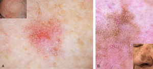 Imagen dermatoscópica de la QA. A) Patrón clásico en fresa. B) Retículo pigmentado en la variante de QA pigmentada. QA: queratosis actínica.