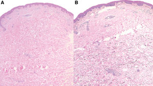 A)Histología con tinción de hematoxilina y eosina [40×]. B)Histología con tinción de orceína [40×].