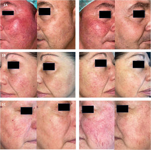 Ejemplos de fotografías de pacientes previas y posteriores al tratamiento. A) El paciente recibió 4 sesiones. La primera con Nd:YAG para rastrear las telangiectasias de mayor tamaño (8mm punto, duración del pulso de 20ms con modo simple, fluencia 60J/cm2), seguida de KTP 10mm, 10ms en modo simple y 10J/cm2. Se realizó una segunda sesión con parámetros similares, seguida de 2 sesiones de 2 pases de láser KTP en modo simple de submilisegundos. B) El paciente recibió 5 sesiones de láser KTP en modo pulso simple (10ms) para telangiectasias medias, con punto de 12mm y fluencia que fluctúa de 7 a 8J/cm2, seguida de KTP en modo de pulso de submicrosegundos (10ms) con tamaño de punto de 10mm y fluencia de 8J/cm2 para eritema de fondo. C) Resultados tras 5 sesiones. Se utilizó Nd:YAG para rastrear las telangiectasias de mayor tamaño (punto de 8mm, duración del pulso de 10ms con modo simple, fluencia que fluctúa de 70 a 120J/cm2) seguida de KTP modo simple (10ms, punto de 10 a 12mm y fluencia de 10J/cm2) para vasos medios y modos de submilisegundos y submicrosegundos (tamaño de punto de 10 a 12mm, fluencia de 8 a 10J/cm2 y duración del pulso de 10ms) para vasos pequeños y eritema difuso. Se observó una hiperpigmentación ligera tras la 5.a sesión, que se resolvió en el transcurso de las semanas siguientes.