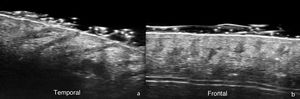 Ultrasound of androgenetic alopecia (70MHz). (A) Normal. Follicles with morphology within normal ranges in the lateral temporal region. (B) Follicular miniaturization and mild widening of hair follicles in the frontal region.