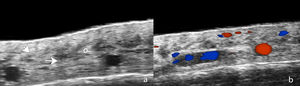 Ultrasound of frontal fibrosing alopecia. (A) Loss of hair follicles (*) and subcutaneous adipose tissue. Loss of definition of the dermohypodermal border (oblique arrow), increased subcutaneous echogenicity (o), and prominent subcutaneous lamellar structures (horizontal arrow). (B) Color Doppler of the same region demonstrates increased dermal vascularization.