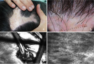 (A) Scarring alopecic plaque in the interparietal area. (B) Trichoscopy: erythema, perifollicular hyperkeratosis, and follicular tufting. (C) RCM: infundibular hyperkeratosis with whitish material filling the infundibulum of the hair follicle and surrounding the hair shaft. (D) Dermis: increased number of poorly defined and thick dermal fibers.