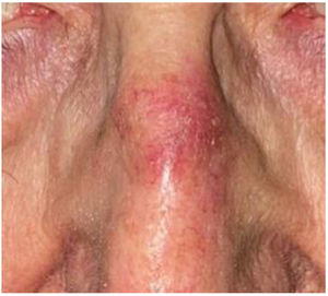 An Overview of Actinic Keratoses: Understanding Etiology, Diagnosis ...