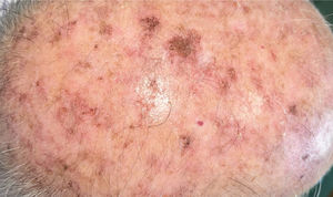 Field cancerization.