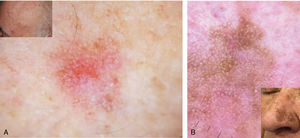Dermoscopic image of AK. (A) Classic strawberry pattern. (B) Pigmented reticulum in the pigmented AK variant. AK: actinic keratosis.