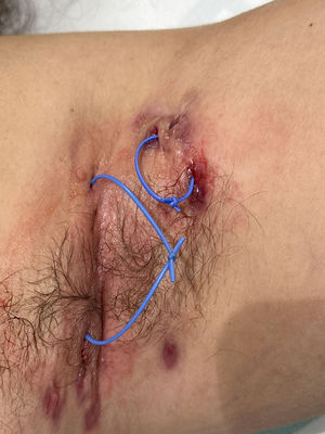 Setons placed in 2 axillary fistulas.