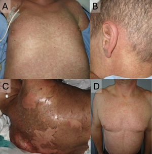 EICR cutánea aguda. A. Exantema maculopapular afectando a tronco, con predominio folicular. B. Afectación retroauricular, característica de la enfermedad. C. Despegamiento epidérmico en un paciente con EICR aguda grado 4. D. Exantema maculopapular afectando a tronco, con predominio folicular. Este paciente fue finalmente diagnosticado de toxicodermia a piperacilina-tazobactam. Nótese la dificultad en el diagnóstico diferencial con la EICR, siendo un caso muy similar al paciente de A.
