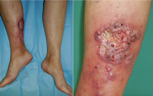A 10cm×7cm plaque, exophytic with ill-defined borders, along with violaceous nodules in the surrounding area. The center of the plaque reveals the presence of an ulcer with a fibrin background, surrounded by vegetative borders, mamillated edges and friable tissue. The lesion exhibited induration and adherence to deeper layers, with serohematic suppuration.