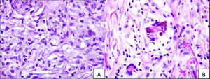 (A) Hematoxylin and eosin staining displays conspicuous oval, transparent structures with a distinct double membrane at the center. (B) PAS-D staining highlights the affirmative response of these structures within a multinucleated cell, situated at the image focal point and enclosed by a well-demarcated membrane.