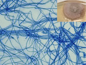 Sabouraud-Chloramphenicol medium petri dish, an ash-colored fluffy colony featuring a faint perimeter and a black undersurface. The microscopic evaluation in lactophenol blue staining revealed dark septate hyphae. The image exhibits conidia with transverse septa positioned at the core of the image.