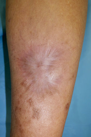 Fungal lesion after extensive surgical excision and antifungal treatment at the 6-month follow-up.