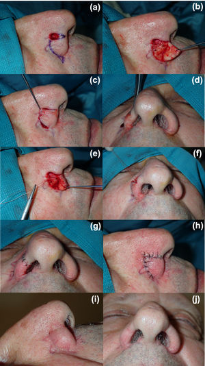 Colgajo de rotación alar empleado para la reconstrucción quirúrgica de defecto localizado en el tercio anterior del ala nasal. (a) Diseño del colgajo, (b y c) movilización y posicionamiento del colgajo. (d) Nótese el estrechamiento de la narina al movilizar el colgajo. (e) Realización de sutura suspensoria transmural anclando el fondo del defecto quirúrgico al borde superolateral del mismo. (f) Apertura del vestíbulo nasal tras sutura suspensoria. (g y h) Resultado en el postoperatorio inmediato. (i y j) A los 2 meses de la intervención, se mantiene la simetría de ambos orificios nasales sin colapso del vestíbulo nasal.