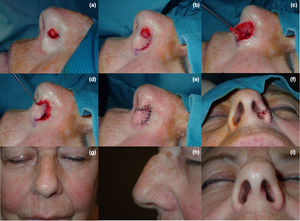 Reconstrucción de defecto quirúrgico en ala nasal mediante CRA. (a) Defecto quirúrgico resultante tras la extirpación completa de carcinoma basocelular. (b) Labrado del colgajo. (c y d) Al posicionar y movilizar el colgajo, se observa una deformidad en «joroba». (e y f) Cierre del defecto tras realizar un triángulo de descarga hacia el borde libre. (g-i) Nótese la ausencia de deformidad una vez realizado el triángulo de descarga.