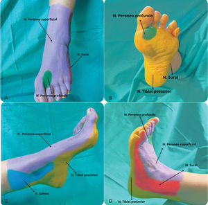 Inervación sensitiva de los nervios tibial posterior (amarillo), peroneo profundo (verde), peroneo superficial (magenta), safeno (azul) y sural (rojo). A: Cara dorsal del pie izquierdo. B: Cara plantar del pie izquierdo. C: Cara lateral interna del pie izquierdo. D: Cara lateral externa del pie izquierdo.
