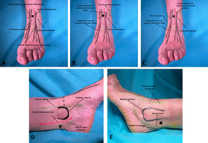 Puntos de inyección A: Nervio peroneo profundo. B: Nervio peroneo superficial. C: Nervio safeno. D: Nervio tibial posterior. E: Nervio sural.