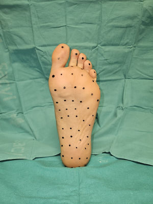 Dibujo de los puntos de inyección de la toxina botulínica.