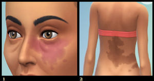 Los Sims. 1) Malformación capilar. 2) Nevus melanocítico congénito.
