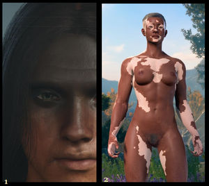 1) Hiperpigmentación facial en Dragon ‘s Dogma. 2) Vitíligo en Baldur ‘s Gate.