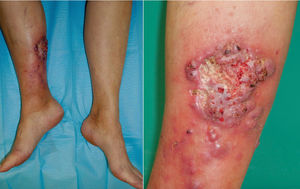 Placa exofítica con bordes bien definidos de 10×7cm, junto con nódulos violáceos en la zona circundante. El centro de la placa revela la presencia de úlcera con trasfondo de fibrina, rodeada por límites vegetativos, bordes mamilados y tejido friable. La lesión mostró induración y adherencia a las capas más profundas, con supuración serohemática.