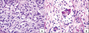 (A) La tinción con hematoxilina-eosina muestra estructuras ovales y transparentes visibles, con membrana doble clara en el centro. (B) La tinción PAS-D destaca la respuesta afirmativa de estas estructuras dentro de una célula multinucleada, situada en el punto de la imagen focal, y delimitada por una membrana bien demarcada.