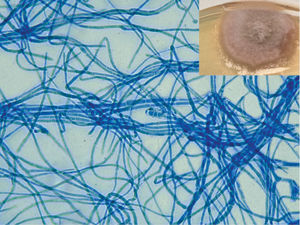 Placa de Petri con medio Sabouraud-cloranfenicol, colonia esponjosa de color ceniza que presenta un perímetro débil y una superficie inferior de color negro. La evaluación microscópica de la tinción de azul de lactofenol reveló hifas tabicadas oscuras. La imagen muestra conidias con septos transversos situados en el centro de la imagen.