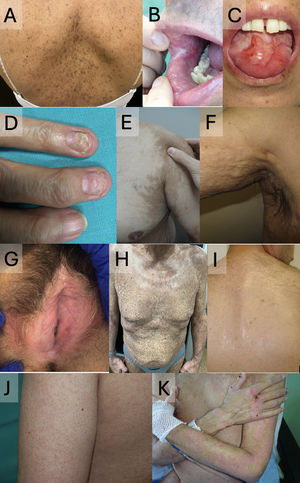 Chronic mucocutaneous GVHD. A–C. Lichen planus-like pattern affecting the back (A), labial and buccal mucosa (B), and tongue (C). D. Nail involvement with onycholysis and pterygium formation. E. Scleroderma-like pattern with secondary hyperpigmentation. F. Fasciitis-like pattern. G. Genital mucosa involvement with sclerodermiform, lichen sclerosus-like changes. H. Poikiloderma-like pattern. I. Lichen sclerosus-like pattern with extragenital involvement on the back. J. Keratosis pilaris-like pattern. K. Psoriasiform pattern.