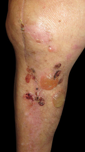 Tense serohemorrhagic blisters and crusts around the surgical scar.