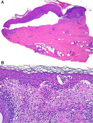 (A) Subepidermal blister with minimal inflammatory infiltrate (H&E ×40). (B) Eosinophilic spongiosis and microvesiculation (H&E ×200).