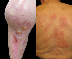 (A) Recurrence of tense blisters and erosions localized around the arthroplasty scar. (B) Urticarial-like plaques without epidermal detachment, generalized on the trunk and neck, six weeks after the first flare.