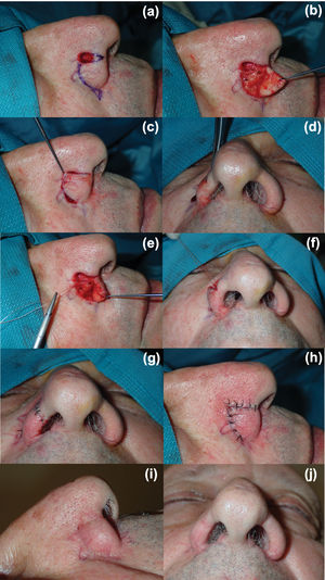 Alar rotation flap used for the surgical reconstruction of a defect located in the anterior third of the nasal ala. (a) Flap design; (b and c) mobilization and positioning of the flap. (d) Note the narrowing of the nostril upon flap mobilization. (e) Placement of a transmural suspension suture anchoring the base of the surgical defect to its superolateral border. (f) Nasal vestibule opening following placement of the suspension suture. (g and h) Immediate postoperative outcome. (i and j) Nasal orifice symmetry is maintained without vestibular collapse 2 months after surgery.