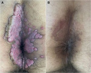 Erythematous exophytic plaque with whitish areas of multiple confluent papules of papillomatous morphology, distributed throughout the anal margin (A). Post-inflammatory hyperpigmentation after treatment (B).