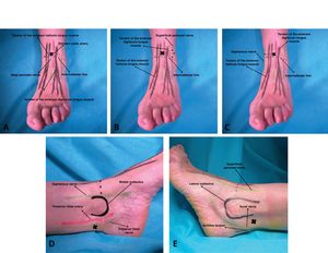 Injection points. (A) Deep peroneal nerve. (B) Superficial peroneal nerve. (C) Saphenous nerve. (D) Posterior tibial nerve. (E) Sural nerve.