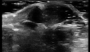 Circumscribed hypoechoic subungual nodule, avascular on Doppler, with partial posterior acoustic shadowing.