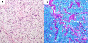 Benign mesenchymal neoplasm with a myxoid appearance and prominent vascularity (A – H&E, 10×) and abundant mucin production, confirmed by specific staining (B – Colloidal iron, 10×).